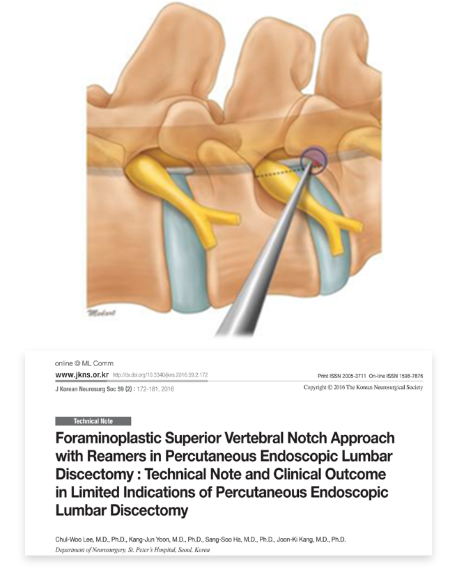 세계 척추 수술